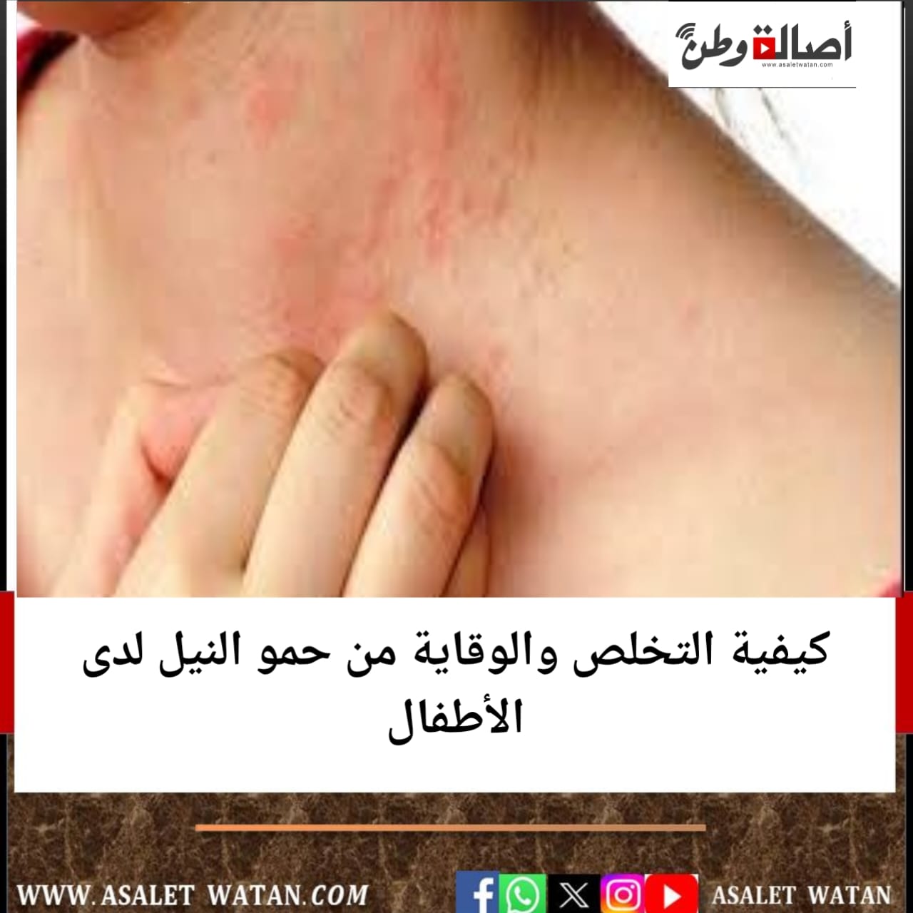 كيفية التخلص والوقاية من حمو النيل لدى الأطفال