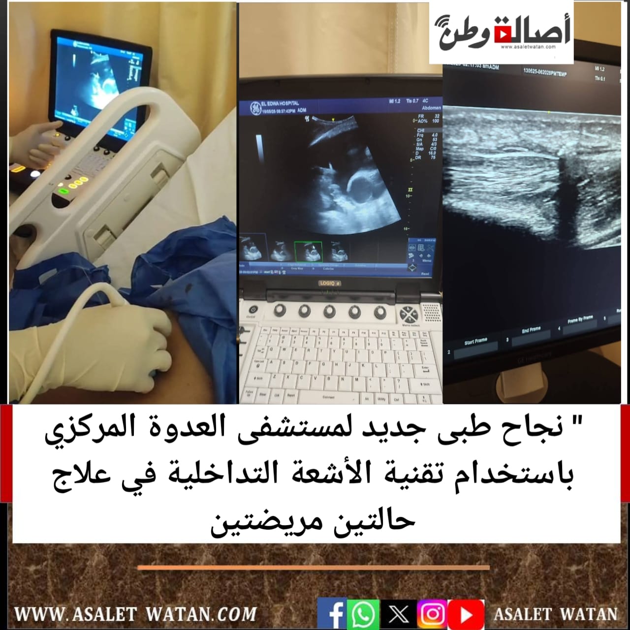 ” نجاح طبى جديد لمستشفى العدوة المركزي باستخدام تقنية الأشعة التداخلية في علاج حالتين مريضتين