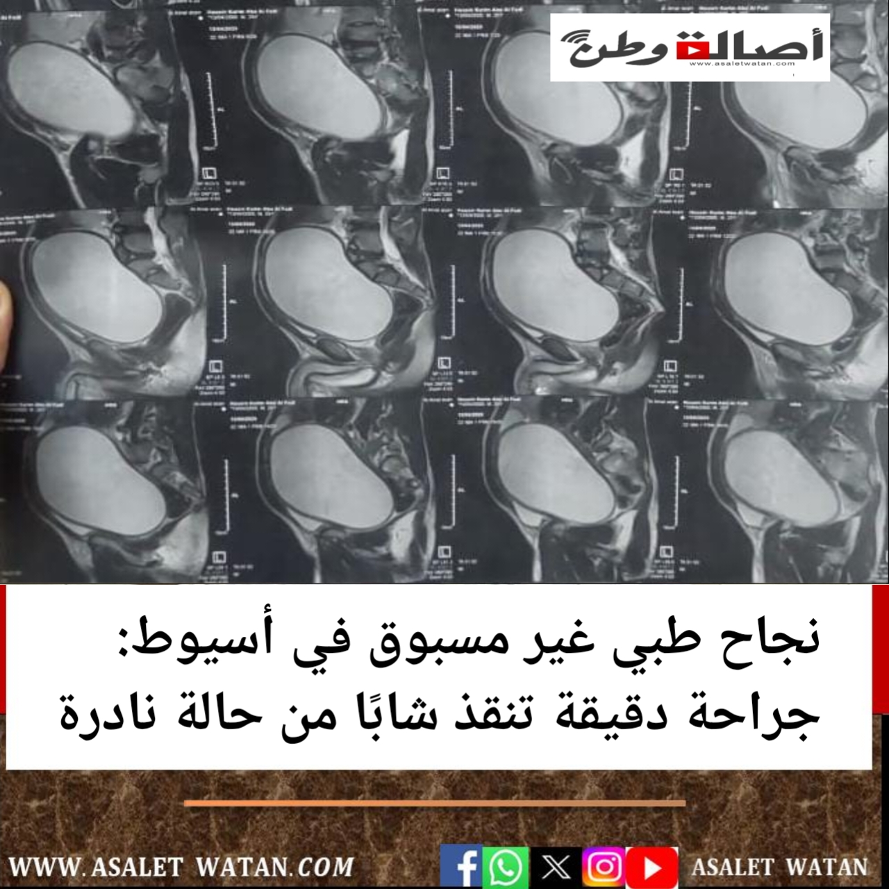 نجاح طبي غير مسبوق في أسيوط: جراحة دقيقة تنقذ شابًا من حالة نادرة