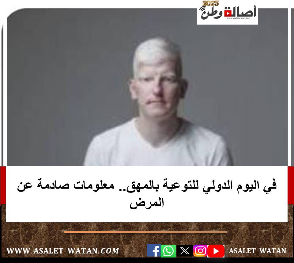 في اليوم الدولي للتوعية بالمهق.. معلومات صادمة عن المرض
