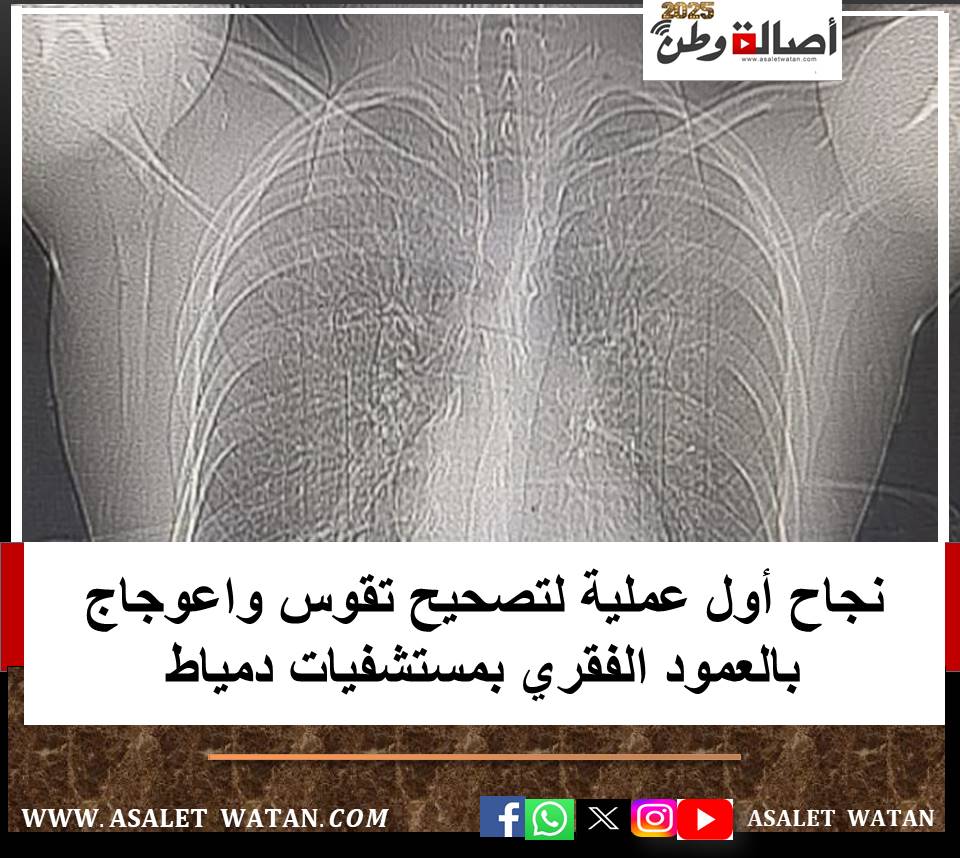 نجاح أول عملية لتصحيح تقوس واعوجاج بالعمود الفقري بمستشفيات دمياط